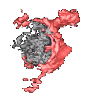 3D US of a colonic metastasis to the liver