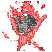 3D US of a lung squamous cell metastasis to the liver