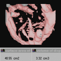 3D measurement of a tumour vascularity