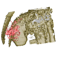 3D CT image of hepatic metastasis of gastrinoma