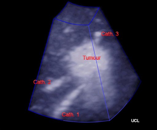 Live 3D ultrasound guided tumour ablation