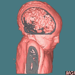 3D MRI brain
