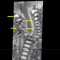 malformed vertebrae