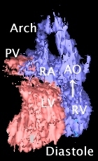 DORV diastolic movie, GIF 307KB