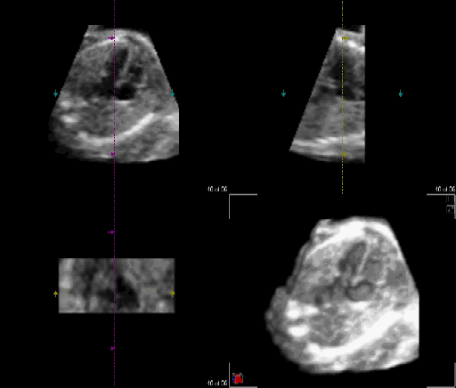 Live 3D ultrasound of a normal fetal heart at 23 weeks