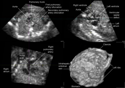 Live 3D ultrasound of a fetal heart with tetralogy of Fallot at 21 weeks