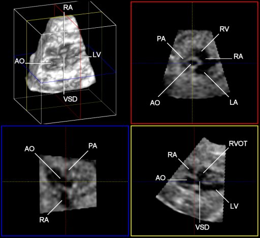 Live 3D ultrasound of a fetal heart with tetralogy of Fallot at 21 weeks