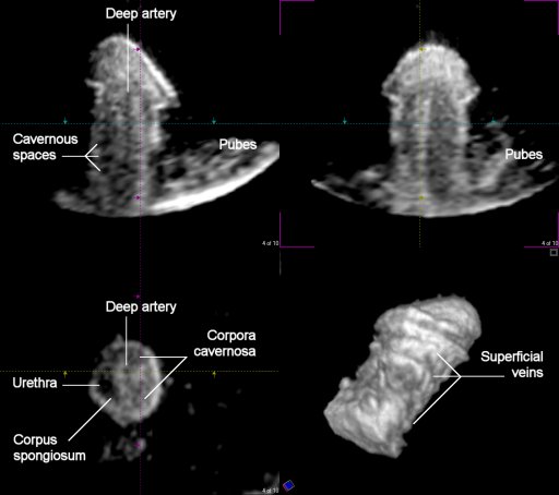 Erecting Penis 3D 4D Imaging UCL