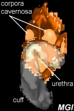 3D MRI artificial sphincter