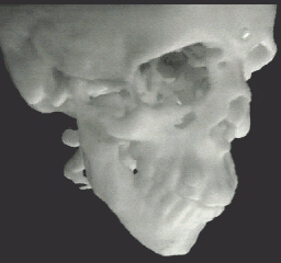 ABS model of patient's skull