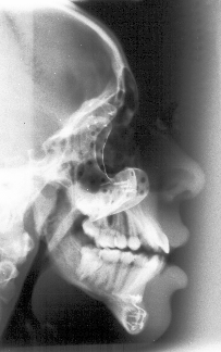Lateral X-ray of patient